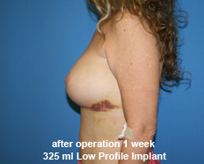 plastic-surgery-breast-augmentation